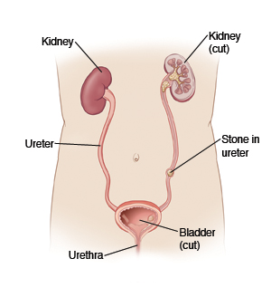 Illustration showing the anatomy of the urinary system, including the kidneys, bladder, urethra, and a stone in the ureter.