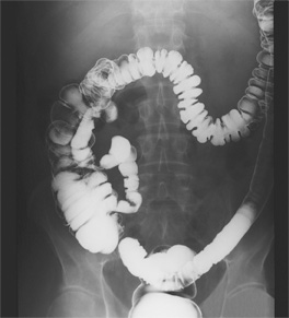 X-ray image of the colon