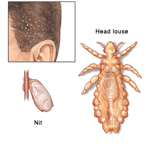 Illustrations showing nit, adult louse, and scalp with nits attached