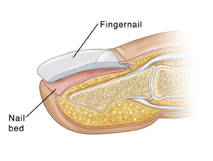 Cross section of fingertip showing complete avulsion of fingernail.