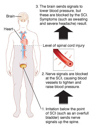 Outline of human figure showing heart, brain, and full bladder. Horizontal line just below heart shows level of spinal cord injury. Detail of blood vessel with arrows outside it showing pressure on vessel. Irritation below point of SCI (such as an overfull bladder) sends nerve signals up spine. Nerve signals are blocked at SCI, causing blood vessels to tighten and raise blood pressure. Brain sends signals to lower blood pressure, but these are blocked by SCI. Symptoms such as sweating and severe headache result.