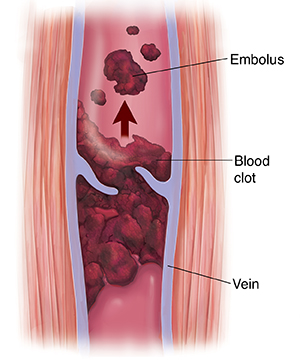 Cross section of muscle and varicose vein with blood clot and embolus.