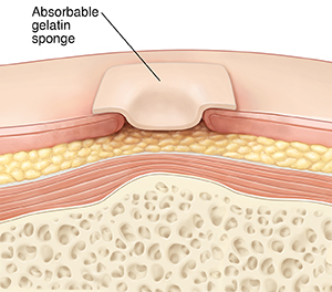 Cross section of skin with wound showing absorbable gelatin sponge dressing. 