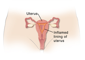 Front view cross section of vagina and uterus, showing inflamed lining of uterus.
