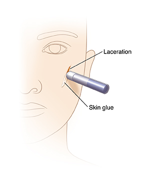 Face with laceration showing skin glue closing wound.