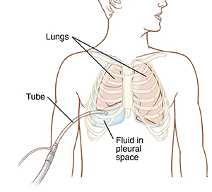 Front view of man's chest showing tube draining fluid from space next to lung.