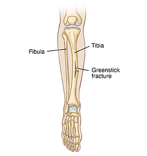 Front view of leg and foot bones showing greenstick fracture of tibia.