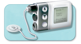 Insulin pump.