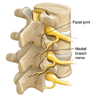 Three-quarter view ng tatlong vertebra at mga disk na ipinakikita ang gulugod, spinal nerves at medial branch nerves.