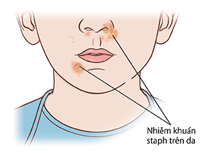 Cận cảnh vùng mặt dưới và cổ. Nhiễm khuẩn staph gây đau trên mũi và gần miệng.