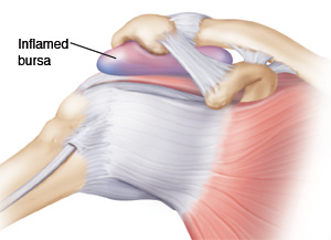 Bursitis