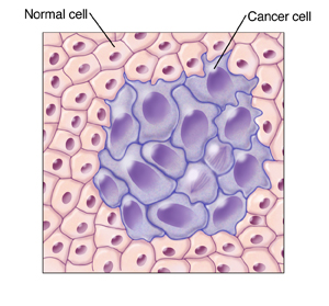 Closeup of normal, regularly shaped cells with a mass of large, abnormally shaped cancer cells in the middle.