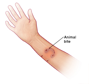 Forearm and hand with palm side up showing animal bite on arm.