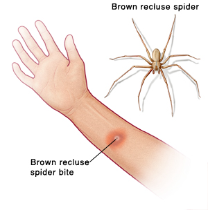Palm view of hand and forearm showing brown recluse spider bite on arm. Picture of brown recluse spider.