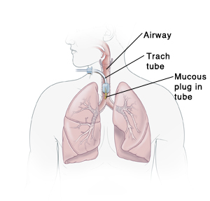 Outline of a body showing the airway, trach tube, and mucous plug in tube