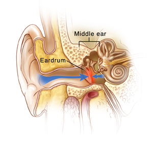 Arrow signifying high pressure pushing against eardrum on external ear side and arrow signifying low pressure pushing against eardrum on middle ear side. Labels include: Eardrum, Middle ear.