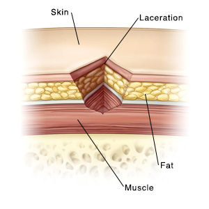 A cross-section of skin showing muscle, fat, and a laceration.