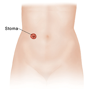 Front view of female torso and pelvis showing urinary stoma after cystectomy.