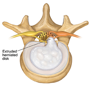 Common Spine and Disk Problems