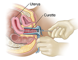 Cross section of female pelvis with speculum in vagina showing gloved hands inserting curette into cervix.