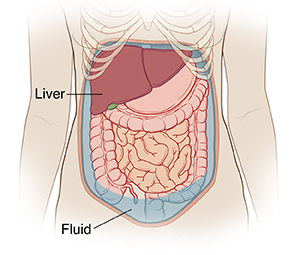 Outline of woman's abdomen showing fluid building up in abdominal cavity.