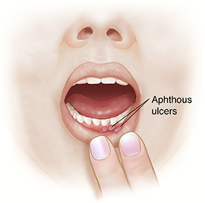 Front view of face with fingers pulling down lower lip to show aphthous ulcers.