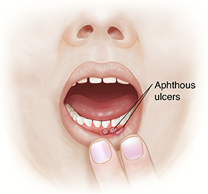 Front view of child's face with fingers pulling down lower lip to show aphthous ulcers.