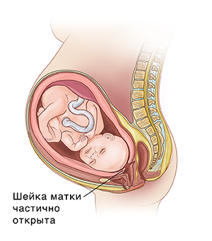 Вид сбоку эмбриона в матке: показано, как шейка матки начинает истончаться и открываться во время преждевременных родов.