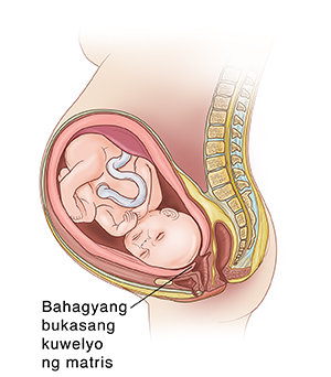 Gilid na kuha ng sanggol sa matris na ipinakikita ang kuwelyo ng matris na nagsisimulang maging manipis at bumubukas sa panahon ng preterm labor.