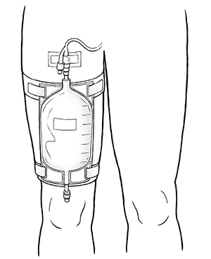 Front view of leg showing urinary catheter bag strapped to thigh and connected to indwelling catheter.