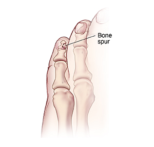 Top view of small toe showing bone spur.
