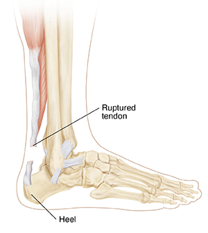 Side view of lower leg showing bones and ruptured achilles tendon.
