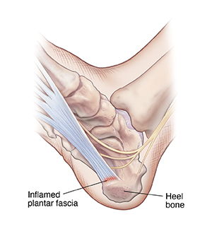 Image of strained plantar fascia
