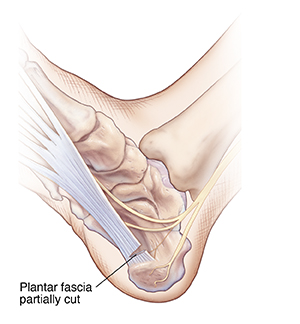 Bottom view of foot showing plantar fascia partially cut near heel.