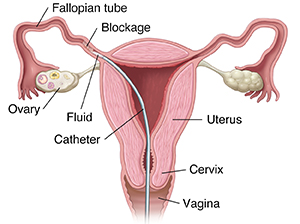 Front view of uterus showing catheter delivering fluid into blocked fallopian tube.