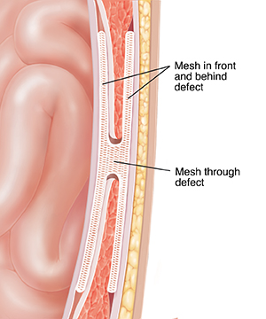 Cross section of abdominal wall showing mesh repair in front of, through, and behind hernia defect.
