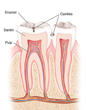 Section through two teeth, gums, and bone showing cavities.