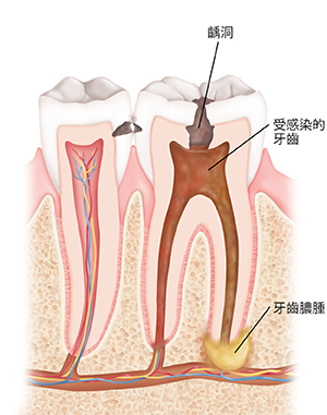 兩顆牙齒的剖面圖,顯示蛀牙、感染和牙膿腫。