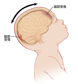 婴儿头部后倾时的侧视图,显示脑的内部情况。箭头指示处在反复摇动状态的头部以及脑前部和后部受到的损伤。