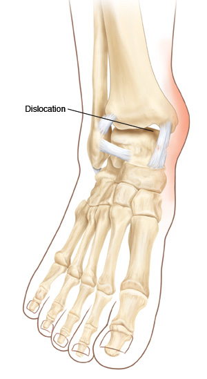Front view of ankle and foot showing ankle dislocation.