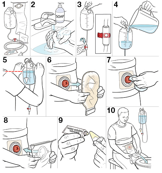 10 steps for getting ready to irrigate your stoma