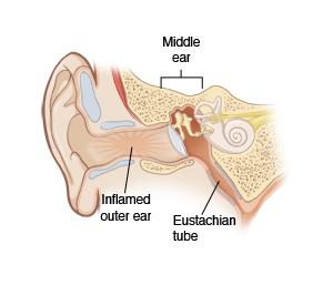 External Ear Infection (Child)