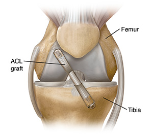 Front view of knee showing graft repair of anterior cruciate ligament.