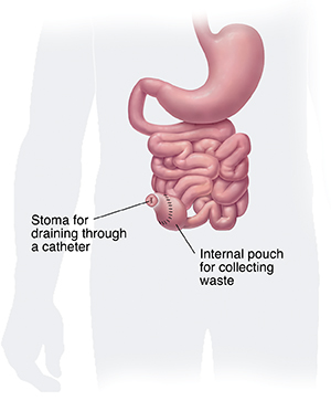 Front view of lower digestive tract with colon and rectum removed, showing stoma and pouch for continent ileostomy. 