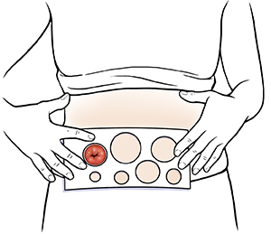 Female abdomen showing hands holding measuring guide to stoma.