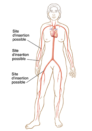 Silhouette féminine montrant les sites d'insertion de cathéter dans l'aine et le bras.
