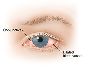 What Is Conjunctivitis?