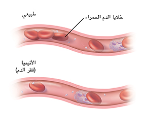 مقطع عرضي للأوعية الدموية مع كميات طبيعية لخلايا الدم الحمراء. وبالأسفل منه يوجد مقطع عرضي آخر للأوعية الدموية يُظهر وجود كميات ضئيلة من خلايا الدم الحمراء بسبب الإصابة بالأنيميا.