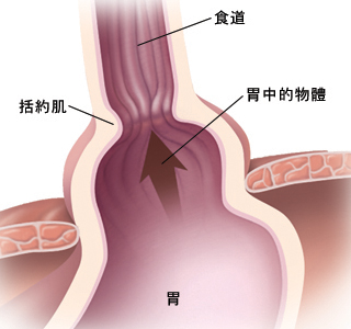 详图显示膈以及允许胃脏顶部和括约肌上移至胸腔的较大开口。胃内容物向上流入食管。