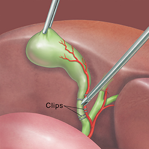 Cholecystectomy